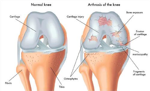 artrose-joelho